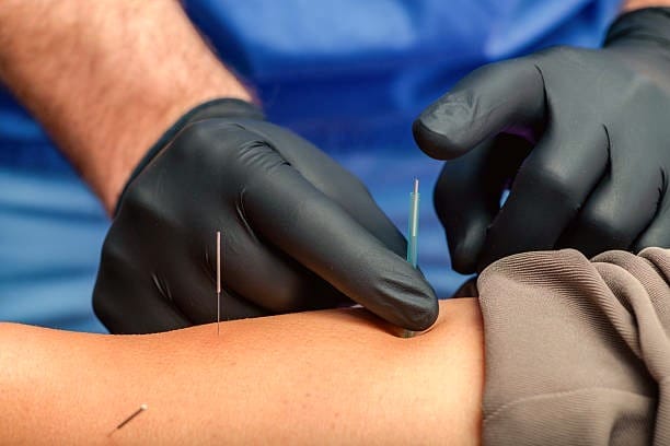 Dry needling treatment being performed on a patient's forearm