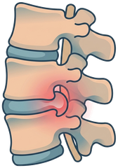 Illustration of a herniated disc pressing on the spine