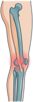 Illustration of the IT band along the outer thigh and knee