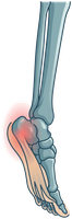 Illustration of the foot and plantar fascia with heel pain