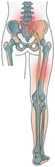 Illustration of a person with radiating lower back pain