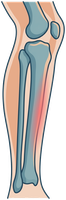 Illustration of the shin bone with pain along the tibia
